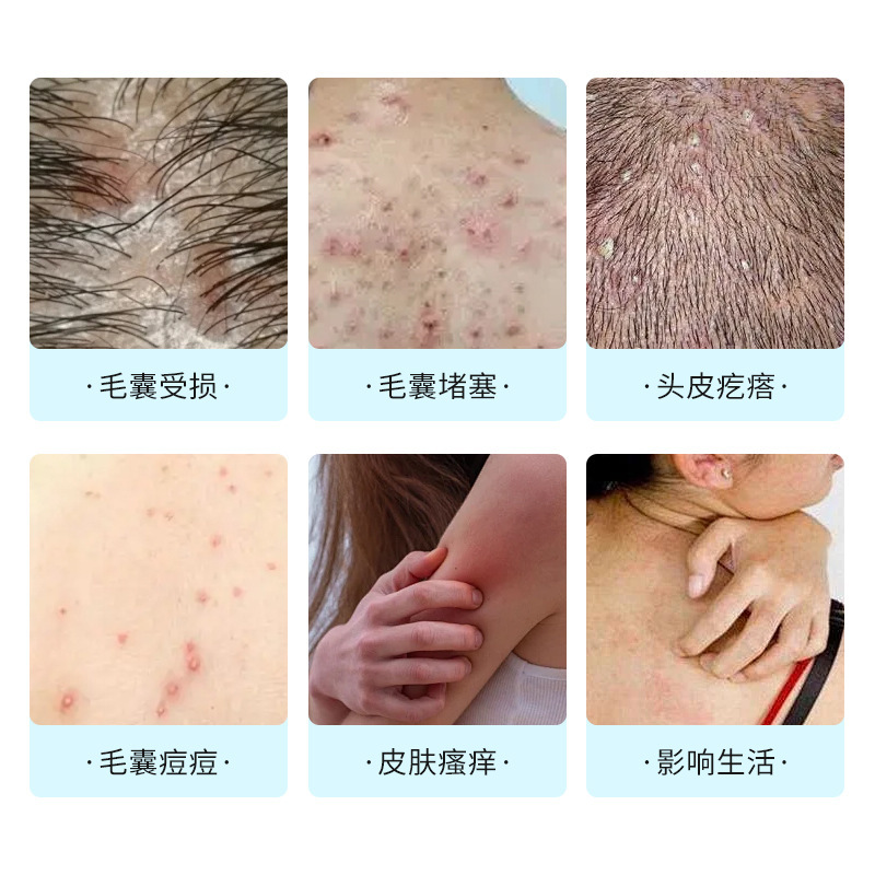 毛包の詰まりを緩和し、損傷した肌のしこりを改善します。杏坂道の枝の生地の毛包の外用保健クリームの卸売りです。|undefined