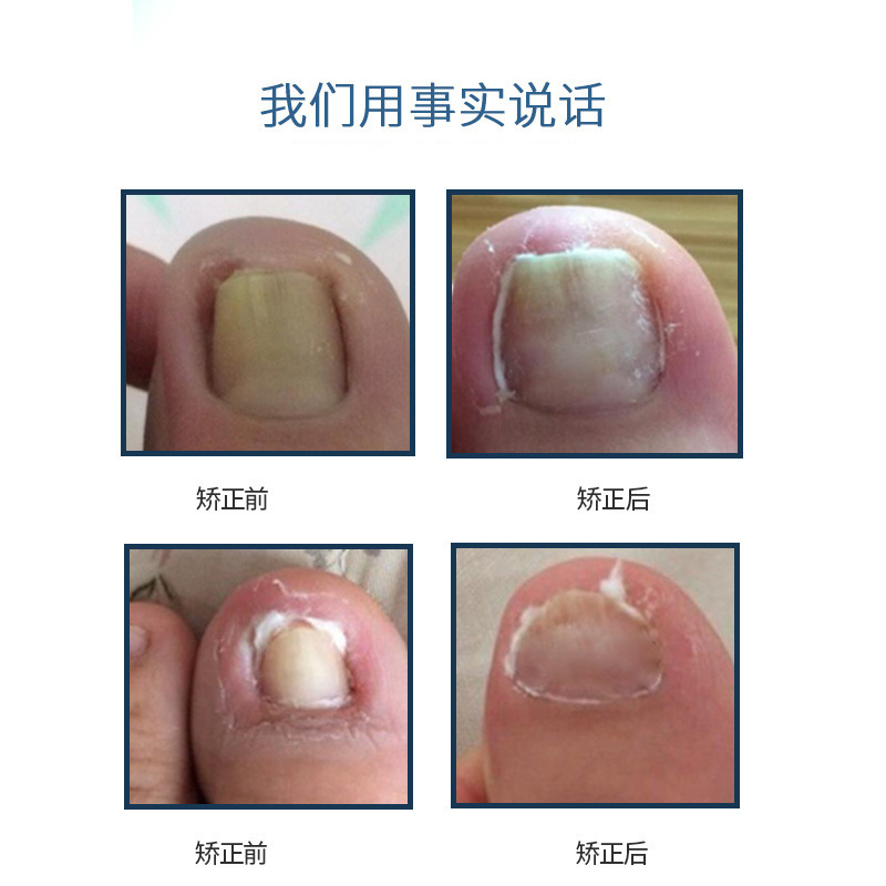 Ingrown Toenail Correction Tool for Correcting Ingrown Nails, Nail Groove Correction, Ingrown Toenail Correction, Toenail Correction Device, Pedicure Tool