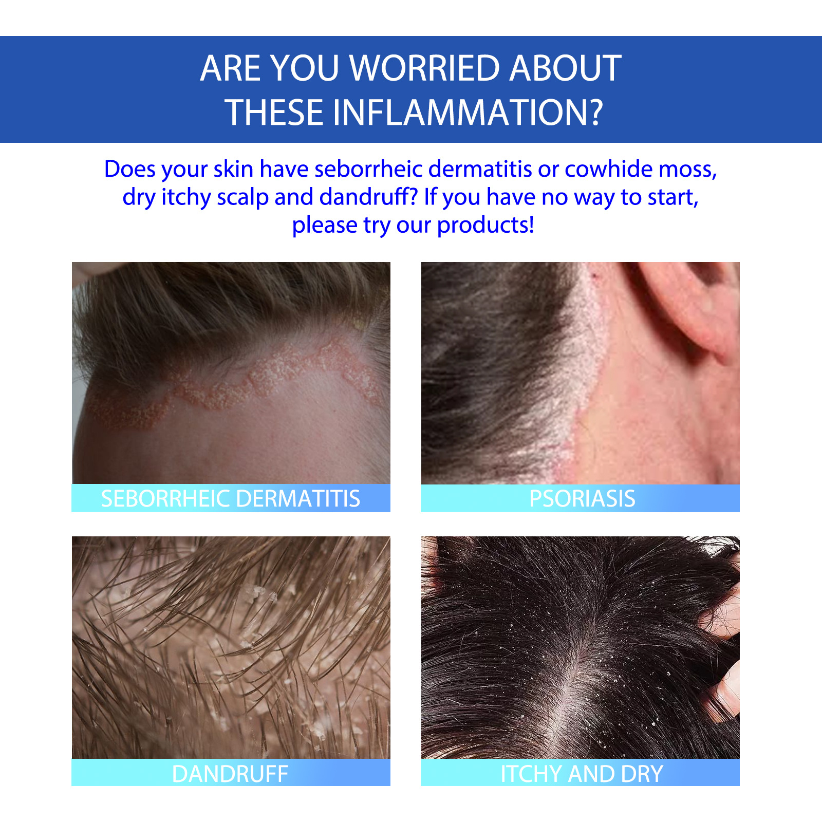 South moon seborrheic skin cream head acne itching scalp ringworm skin problem repair skin cream_voghion.com
