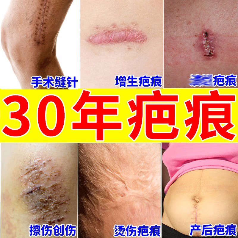 Qudan Scar Cream Repairing Scar Free Genuine Burn Cream Surgical Scar Hyperplasia Repair Cream Beauty Salon Special Scar Cream