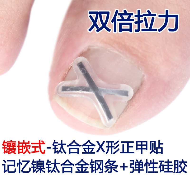 Double-tension X-shaped cross nickel-titanium alloy nail splint for ingrown toenails and paronychia correction
