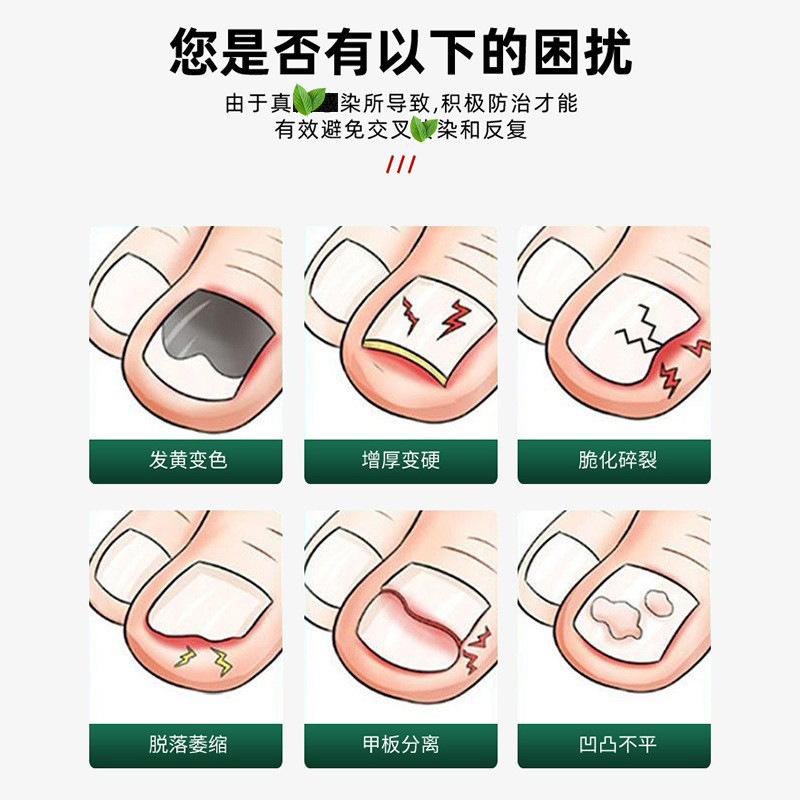 灰指甲趾指甲膏脱甲软甲膏空甲发脆指甲发黄变厚工厂直营|undefined