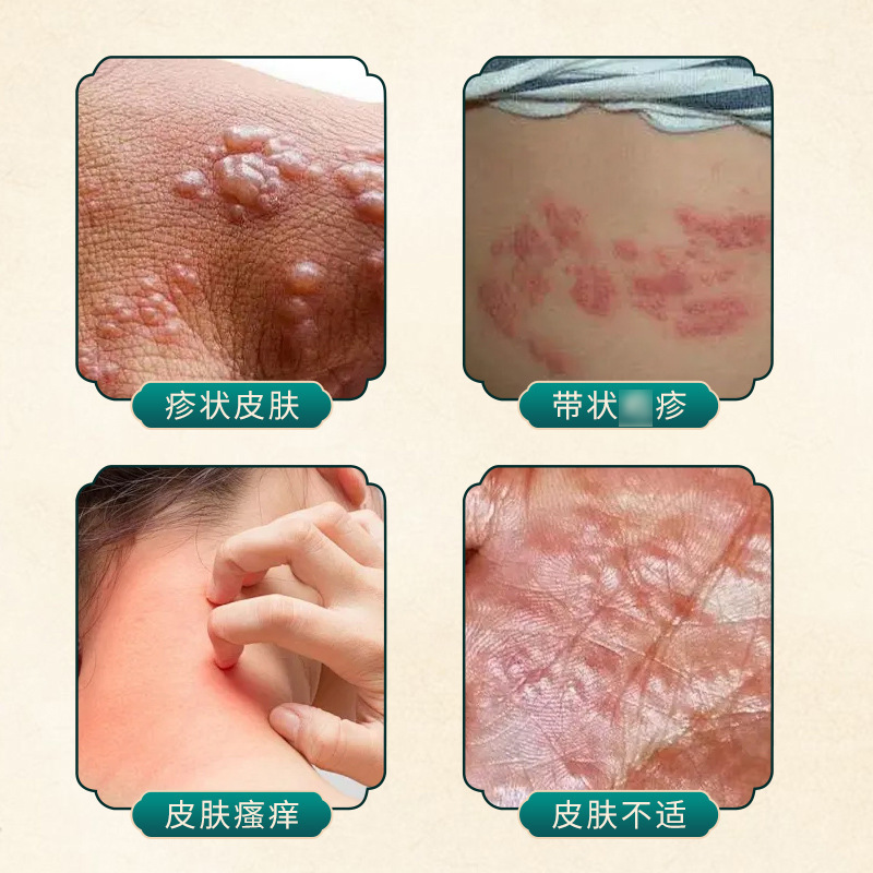 タイは皮膚の泡のかぶれの形の皮膚のかゆみを緩和します。|undefined