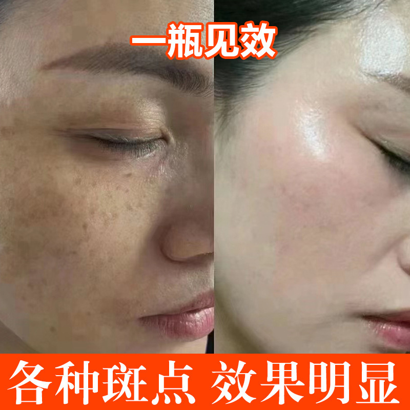 Non-Invasive Spot-Removing Solution That Breaks down Melanin and Fades Spots, Beauty Salon Freckle Removal Solution, Sun Spot Removal Solution, Chloasma Removal Solution Non-Invasive Spot-Removing Solution That Breaks down Melanin and Fades Spots, Beauty Salon Freckle Removal Solution, Sun Spot Removal Solution, Chloasma Removal Solution