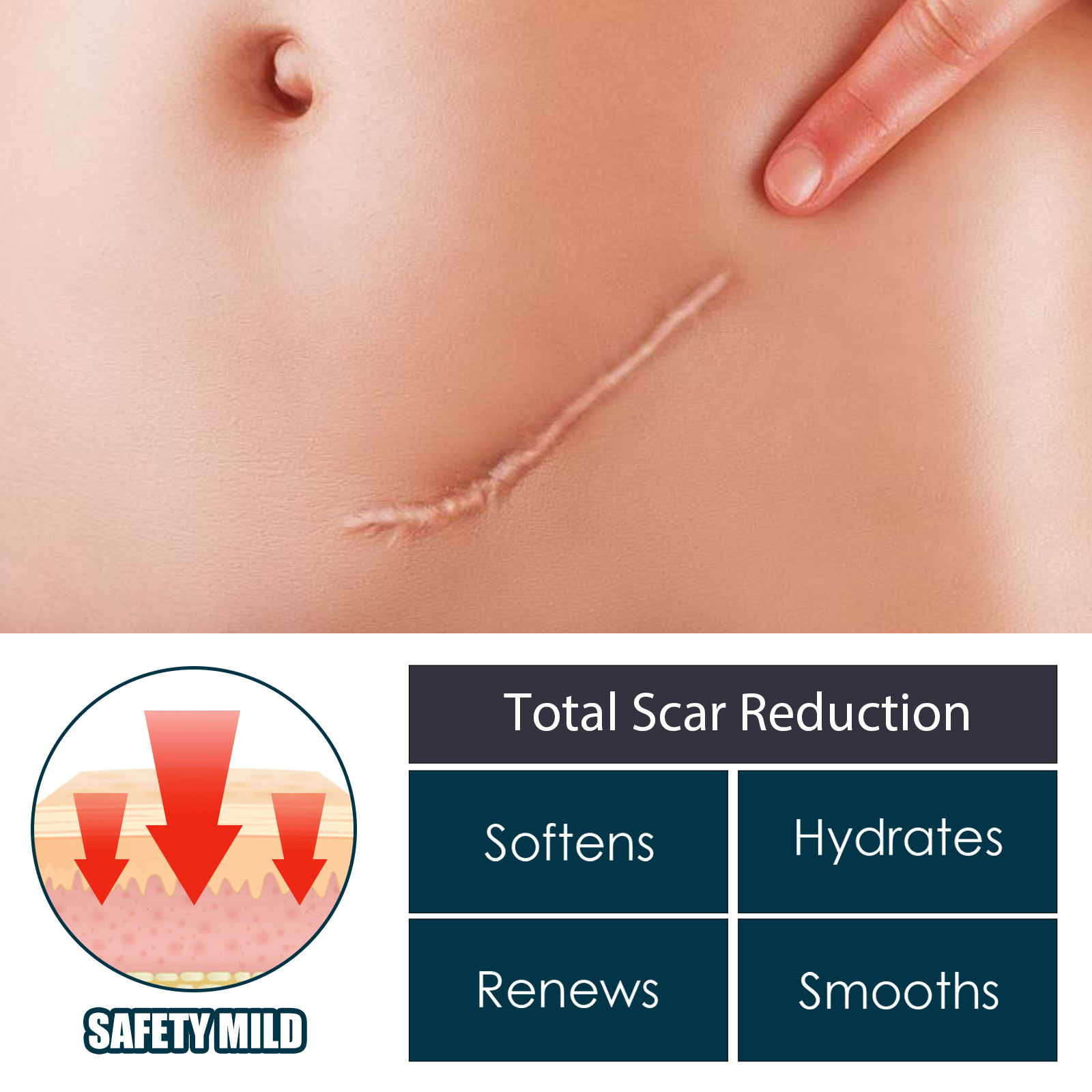 EELHOE littekenverlichtende gel, chirurgische littekenhuidhyperplasie, branden, verzorgen, gladmaken en repareren van littekens, (pak van 3)_voghion.com