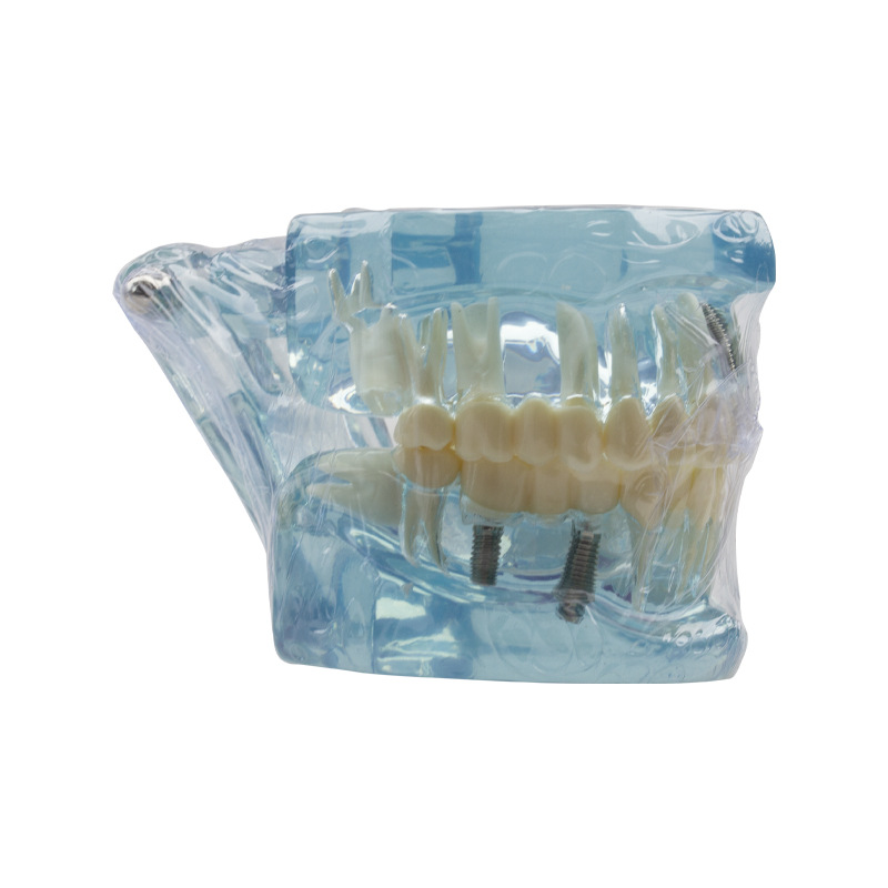 Modelo de implante dental, modelo dental patológico, modelo oral desmontable, modelo de explicación de puente, protección dental