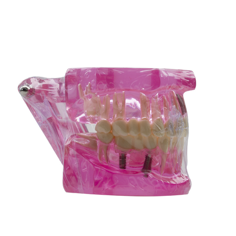 Modelo dental molde modelo dental modelo de enseñanza dental removible dentadura oral cepillado Preparación del diente modelo resina