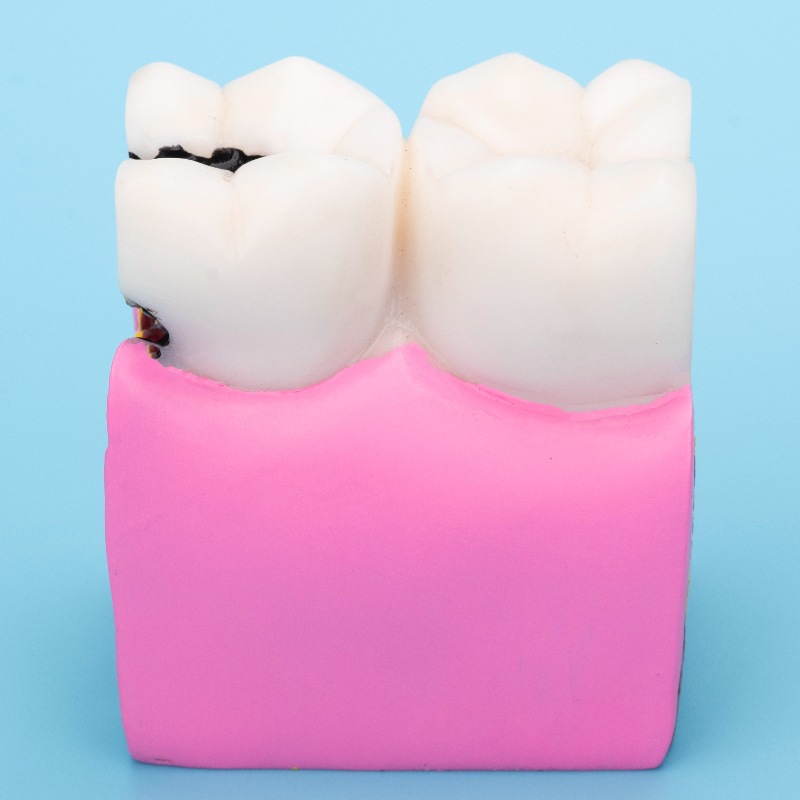 Oral Hospital Doctor-Patient Communication Teaching Model, Dental Bilateral Comparison Display, Denture Teaching Mold Ornaments