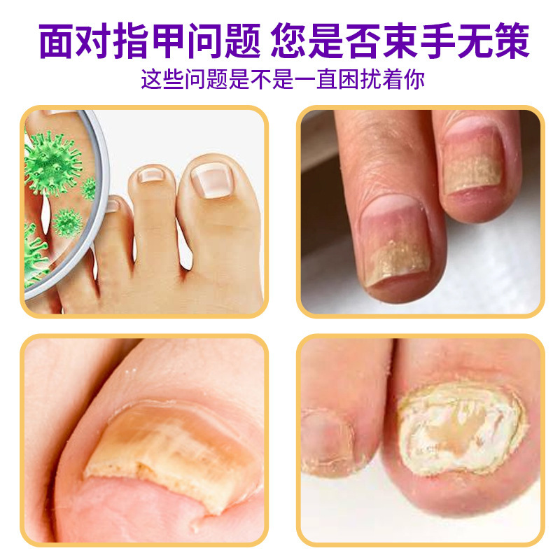 抖快爆款甲康灵喷剂 灰指甲膏去甲脱甲膏足部护理喷雾剂脚气水|undefined
