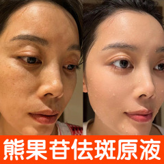 アルブチン原液 黄ばみ除去 美白 シミ・そばかす・色素沈着・黒色素除去 美白美容液