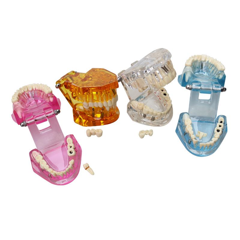 Herramienta de enseñanza de modelos dentales para la comunicación entre paciente y médico, molde dental transparente, modelo de explicación de implantes extraíble para niños.
