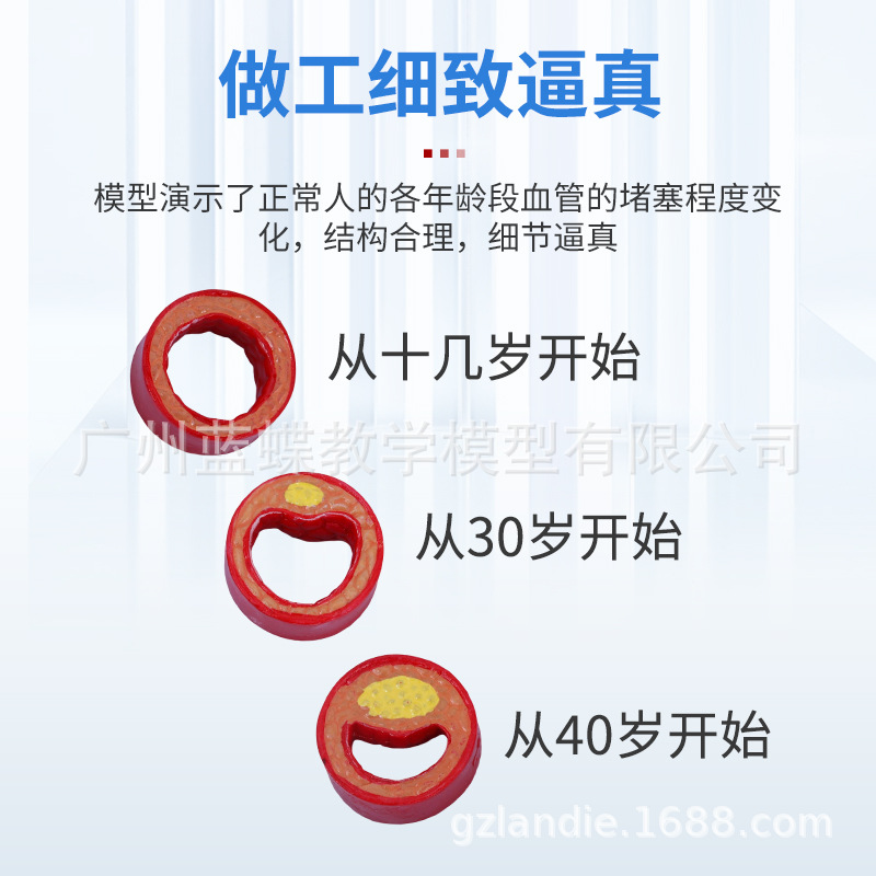 Ѫ�ܷ������Ѫ֬��Ѫ֬ģ�Ͳ�����̬Ӳ������Ѫ˨ֱ�۽�ѧ����