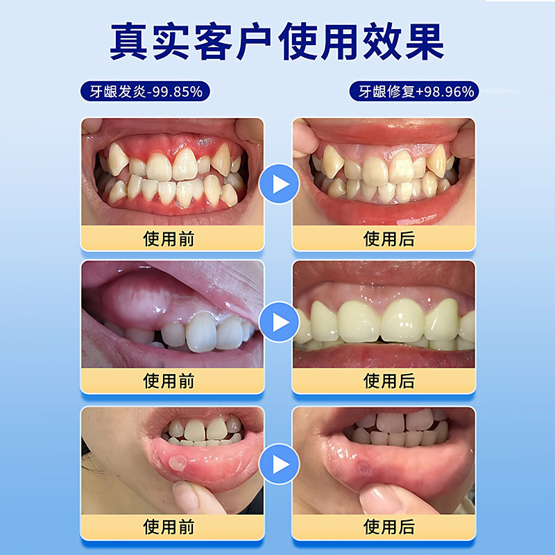 Dr.BorisArzt牙龈肿痛萎缩智齿牙根发炎止疼牙肉牙疼专用神经喷雾|undefined