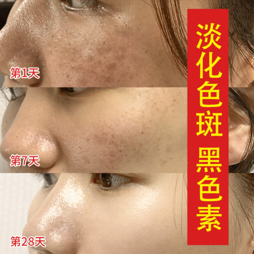 Beauty Salon Astragalus Cream Fades Age Spots and Liver Spots, Moisturizes and Softens Skin, Removes Melanin, Controls Pigmentation, and Whitens Skin