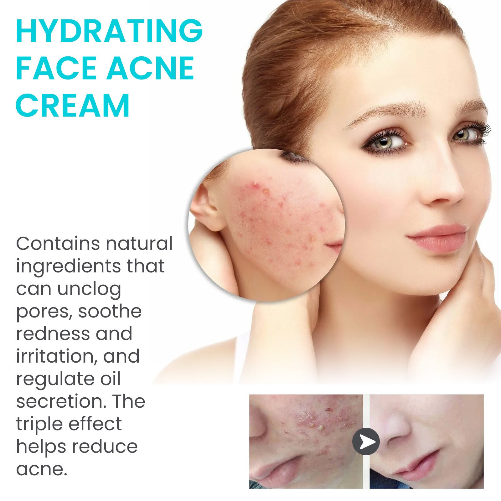 Crema antibrillante Jaysuing para reducir el acné, reducir los poros, hidratar y nutrir la piel,_voghion.com