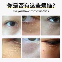 鄒潤安汗管熘膏 眼部脂肪粒緩解汗管粒面部皮膚肉粒乳膏 廠家批發
