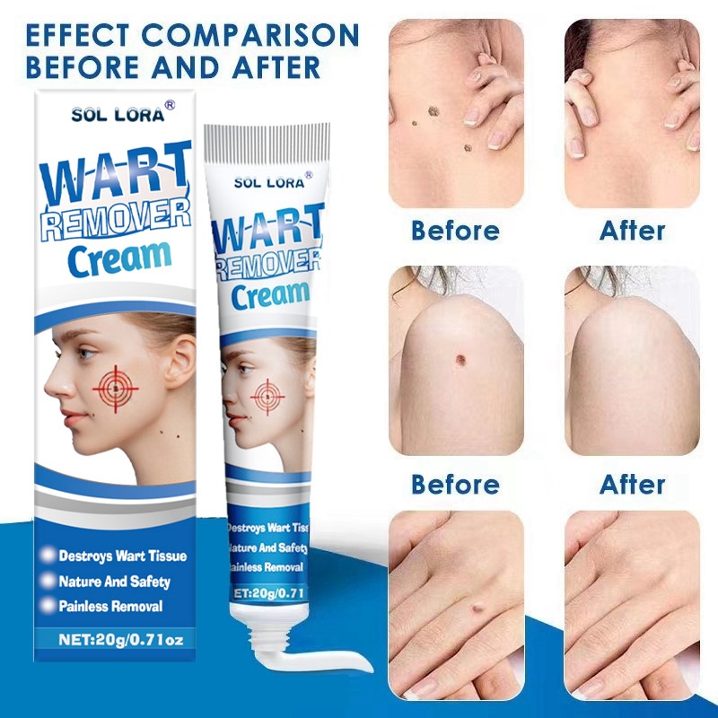 SOL LORA Yama Flat Removal Filamentous Wart Chicken Eye Spot Nevus Cream_voghion.com