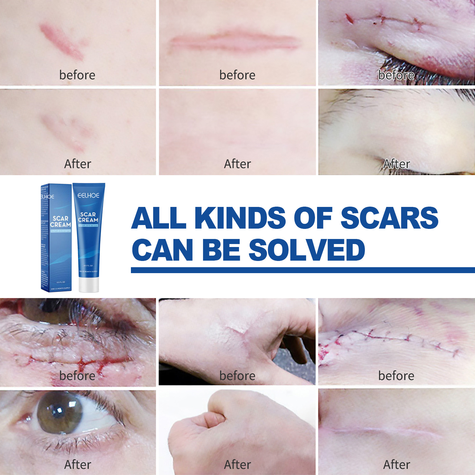 eelhoe skin repair cream scar cream care burns burns prints acne marks fade smoothing care cream scar cream,(Pack of 3)_voghion.com