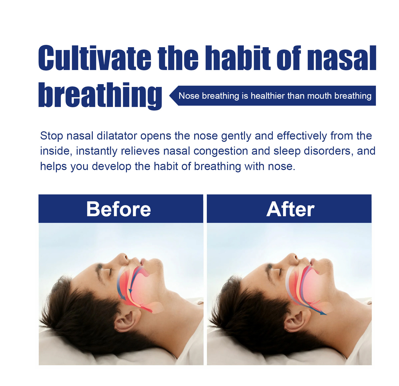 South Moon anti-snoring nasal dilator, anti-snoring and snoring nostril dilation, fixed ventilation, anti-snoring corrector_voghion.com