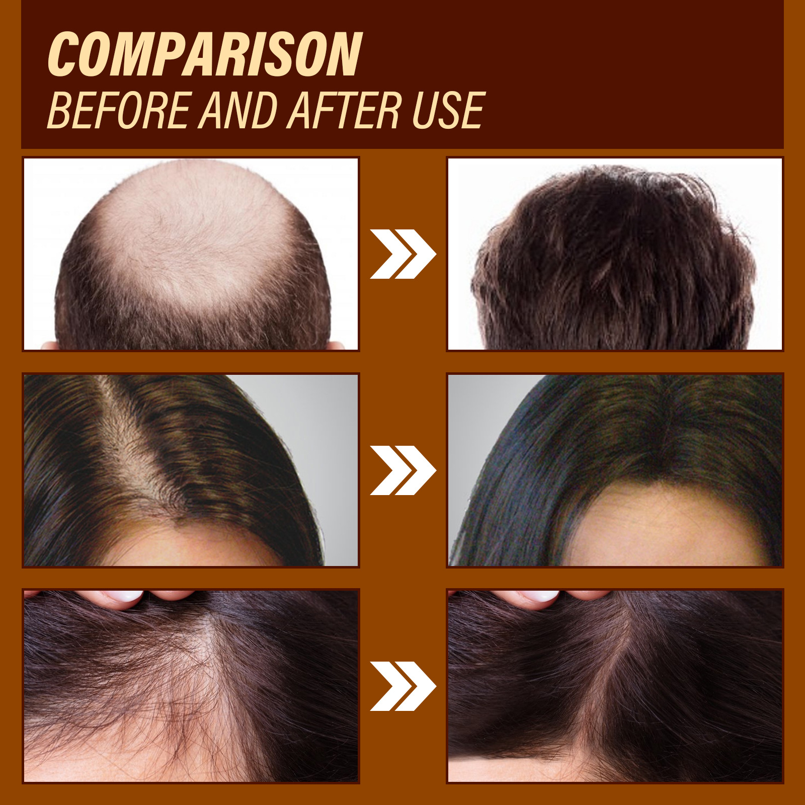 OUHOE Ingvera augšanas esence. Mitrinoša, barojoša, izturīga, atjauno matu folikulu bojājumus, sausiem, apmatotiem matiem._voghion.com