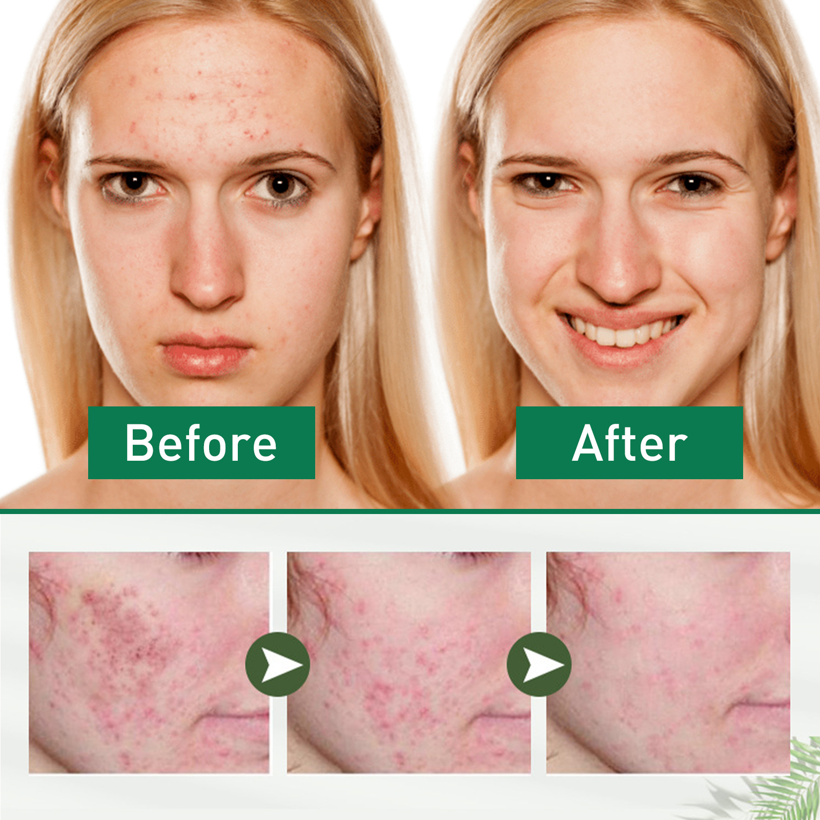 Jayswing Tea Tree Oil Lightens Marks, Moisturizes Repairs Facial Sensitivity, Reddening and Acne Removing essence_voghion.com