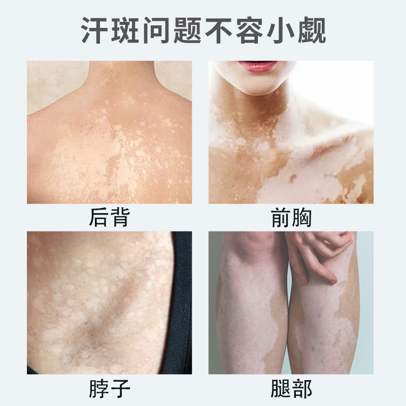 香港薬局汗斑、白い斑点、白い斑点、皮膚の制汗剤、かゆみ止め外用ボディスプレー卸売|undefined