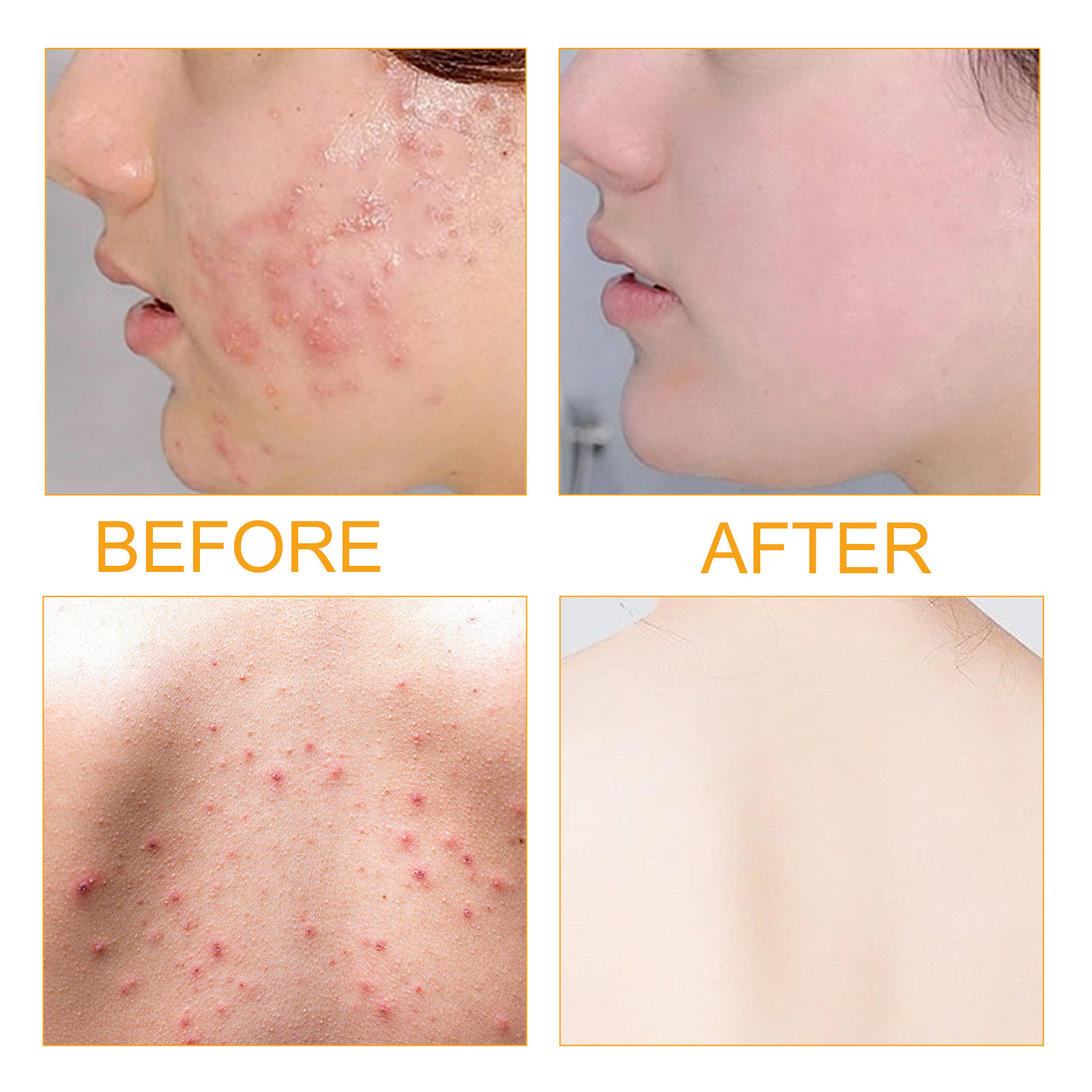 Jayusing Anti Cream Lighten and Acne Marks Esencja do nawilżania i naprawy skóry na ustach_voghion.com