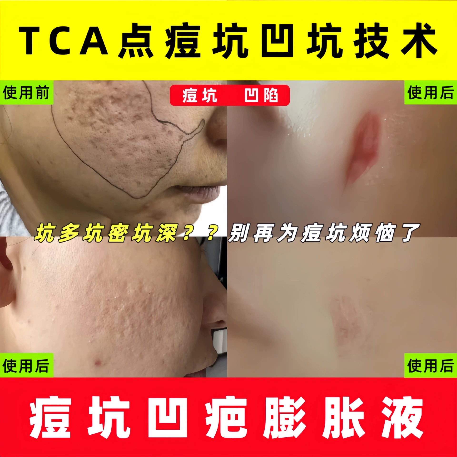 Яма от прыщей набухает, сжимает и полон рубцов