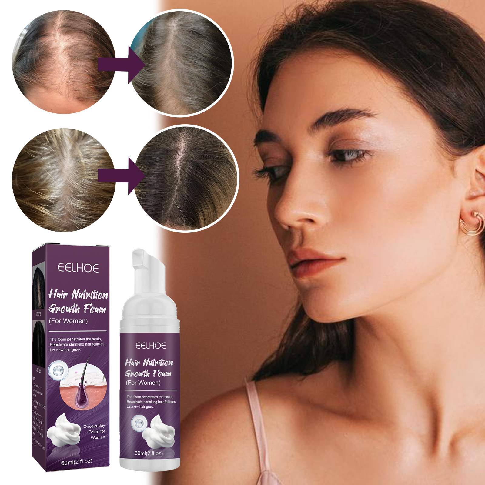 Tratamento em espuma de minoxidil para crescimento capilar_voghion.com