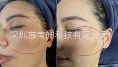 水分離無創微結晶溶斑液溶解黒色素黄褐斑妊娠斑日日焼け斑微結晶は皮を破らない