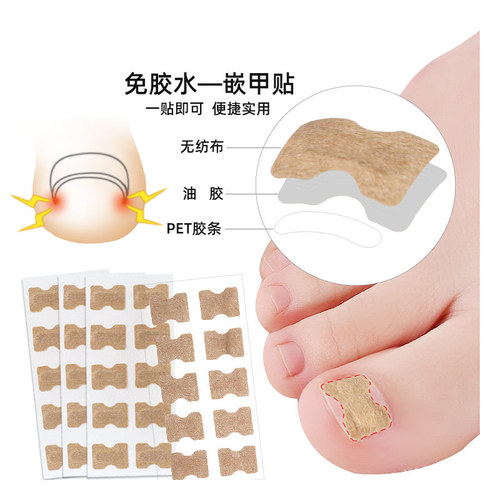 Glue-free nail patch, toenail nail groove, ingrown toenail, orthopedist, toenail patch, pull-up manicure shoes