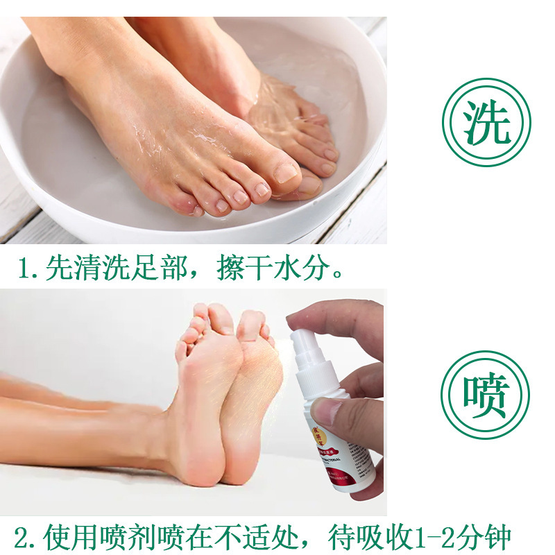 【新バージョンアップ】スキン抗菌液 30ml/本（俗に足王と呼ばれる足・手・皮膚・足の臭い・かゆみ・脱皮にスプレーできます）|undefined
