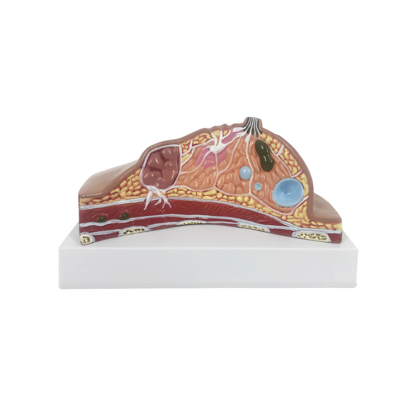 U076C breast lesion model