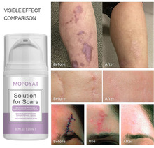 羳MOPOYAT˪caesarean scar burn scar removal repair cream