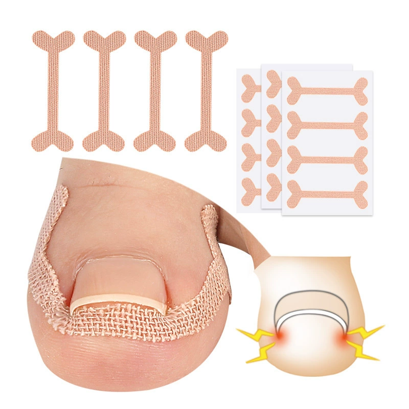 Boji спот через границы, чтобы улучшить встроенный в палец ноги, чтобы облегчить наклейку, чтобы исправить рулон ногтей без боли