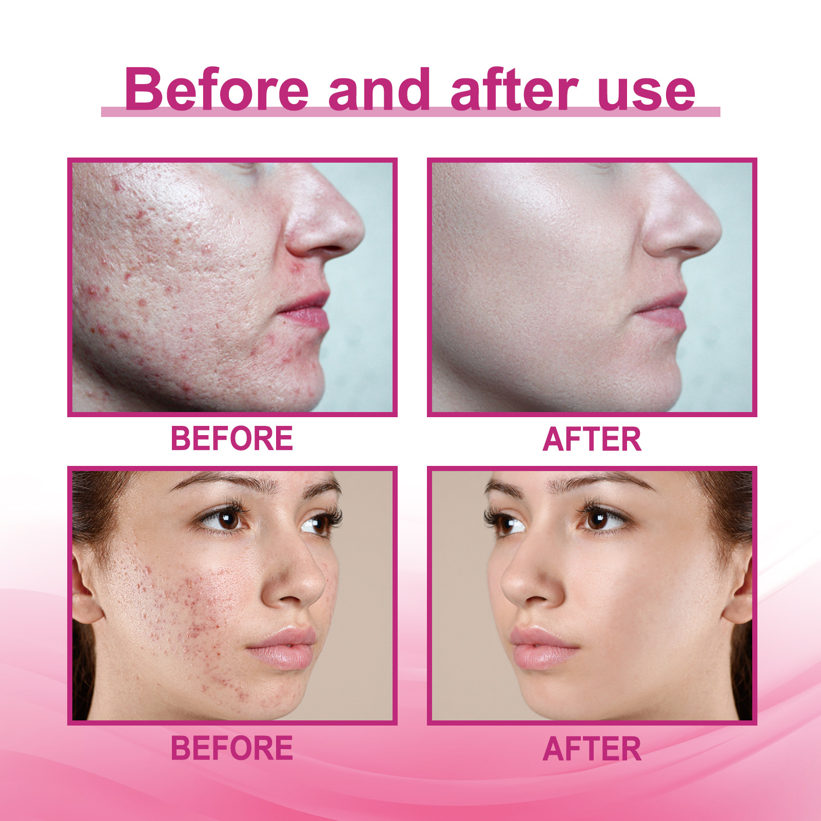 Jayswing Repair Cleaning Pa, atmungsaktiver Concealer, saubere, unsichtbare und transparente Akne-Entfernung_voghion.com