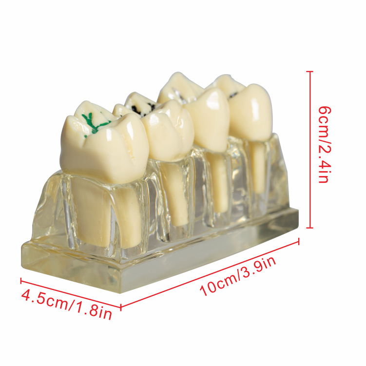 Modelo de cierre de fosas y fisuras dentales para niños contra la caries y la caries Modelo de cierre de fosas y fisuras Modelo transparente