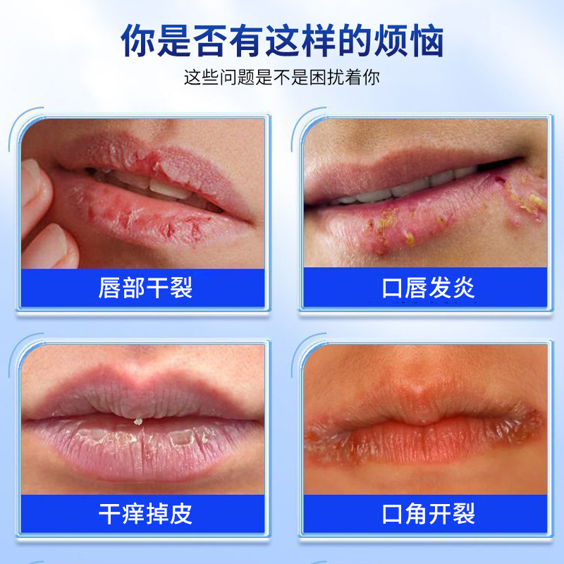 吉雅藤耐牌唇炎クリーム唇部乾燥裂き起皮口唇炎脱皮口角裂き外用保健クリーム|undefined