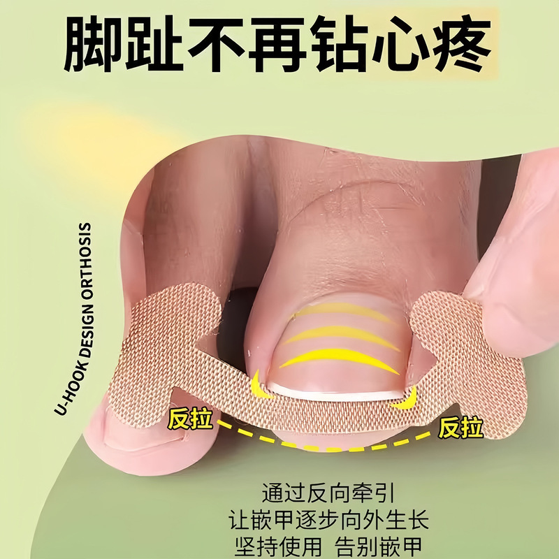 指甲矫正贴正甲贴指甲矫正器脚趾甲长肉里填充垫片纠正炎嵌甲拉贴|undefined