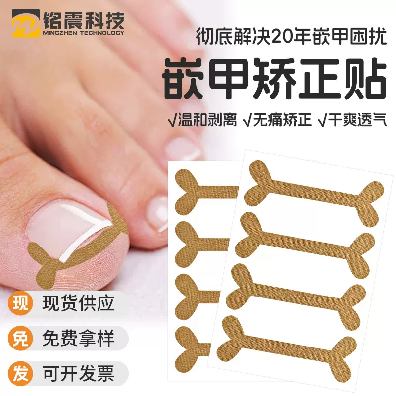 嵌甲Y型免胶水正甲贴脚指甲矫正贴甲沟脚部拉拉贴自粘矫正指甲贴