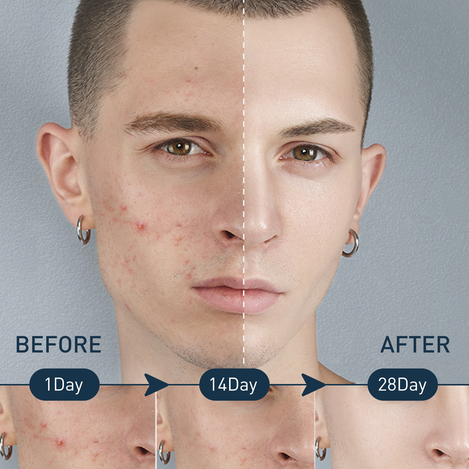Essenza detergente per l'acne oligopeptidica da uomo: ottieni una pelle più chiara oggi stesso!_voghion.com