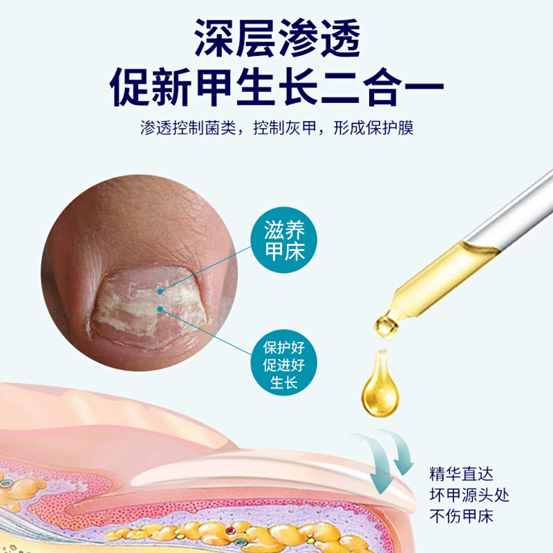 Deshikang Onychomycosis 植物エキスは爪の根に栄養を与え、深く浸透します。|undefined