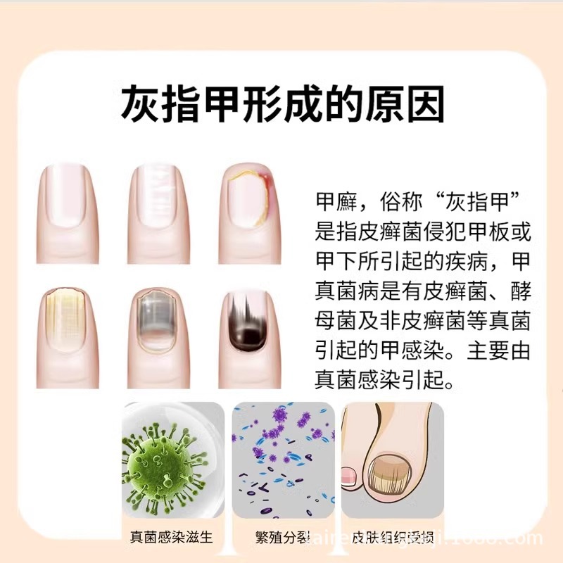 Máquina de fototerapia de uñas grises, lámpara de hongos láser, tratamiento de limpieza, esterilización ultravioleta azul, aparato de enfermería de uñas grises JJ