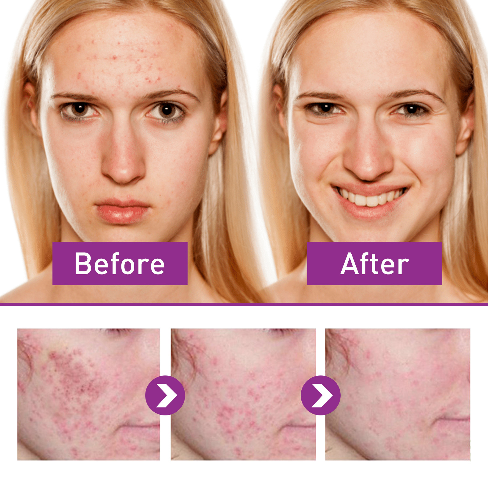 EELHOE Spot Lightening Whitening Cream mindert Akneflecken, repariert dunkle Flecken, spendet Feuchtigkeit, festigt und verbessert die Haut_voghion.com