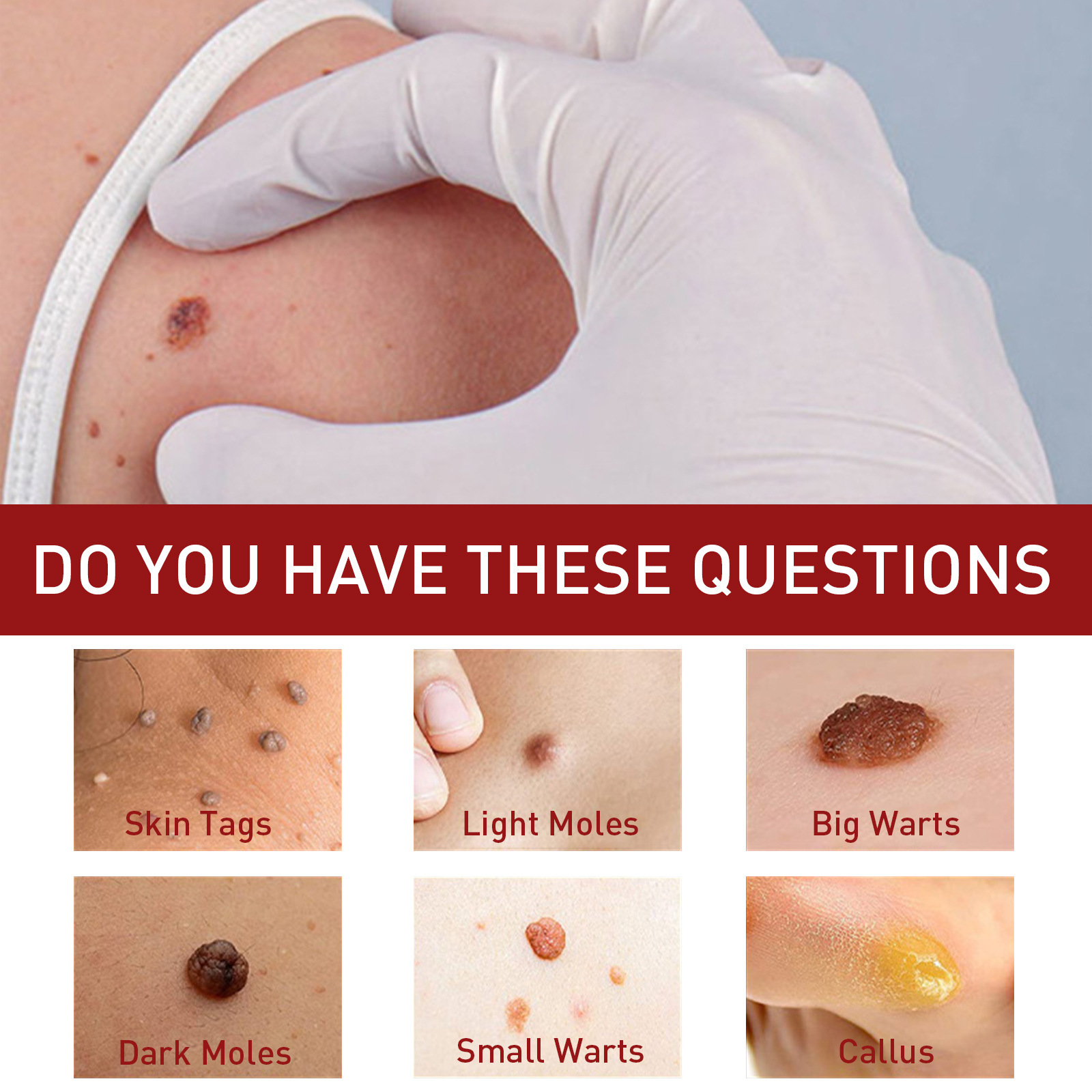 „South Mole“ apgamų šalinimo skystis, gilus odos valymas, karpų mažinimas, juodųjų apgamų atstatymas, odos lyginimo skystis_voghion.com