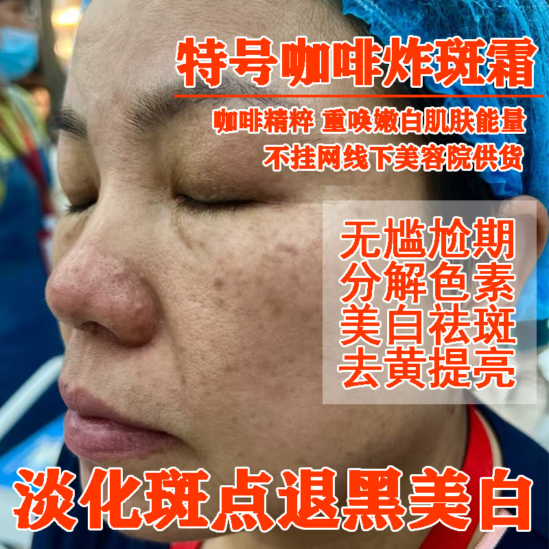 病院で人気の強力なシミ取りクリーム、美白クリーム、メラニンを分解して肌を明るくするクリーム、色調をコントロールするクリーム|undefined