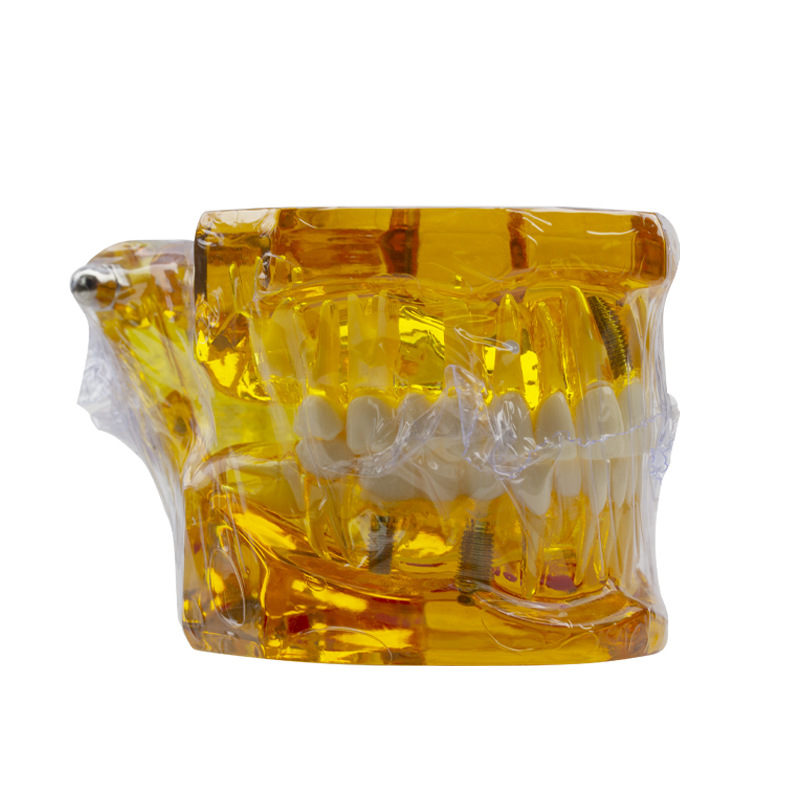 Modelo de implante dental, modelo dental patológico, modelo oral desmontable, modelo de explicación de puente, protección dental