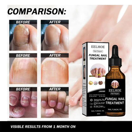 EELHOE Nail Repair Solution Thickening Bright Nails Remove Onychomycosis Dead Skin Repair Moisturizing Nail Art Nutritional Care Solution