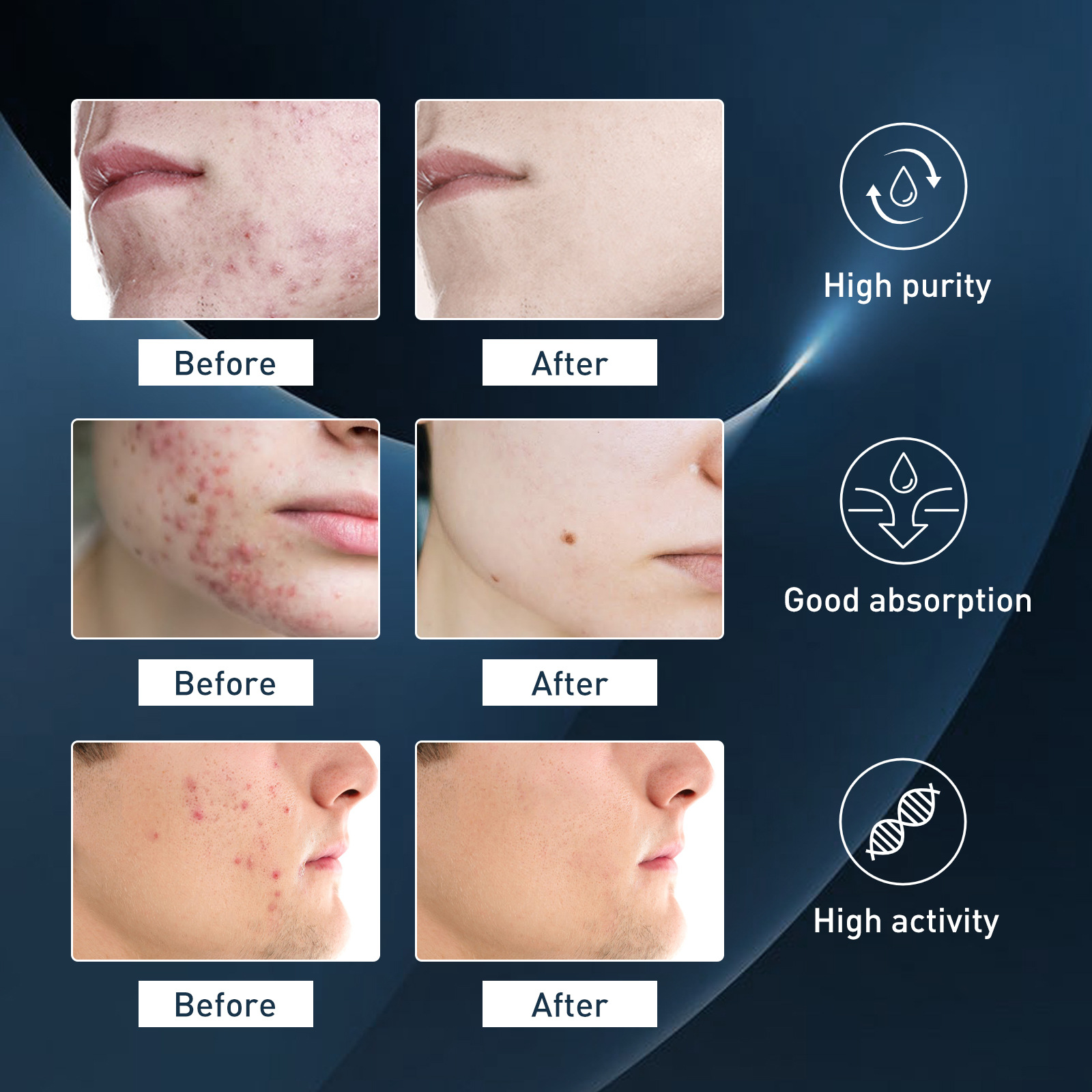Essenza detergente per l'acne oligopeptidica da uomo: ottieni una pelle più chiara oggi stesso!_voghion.com