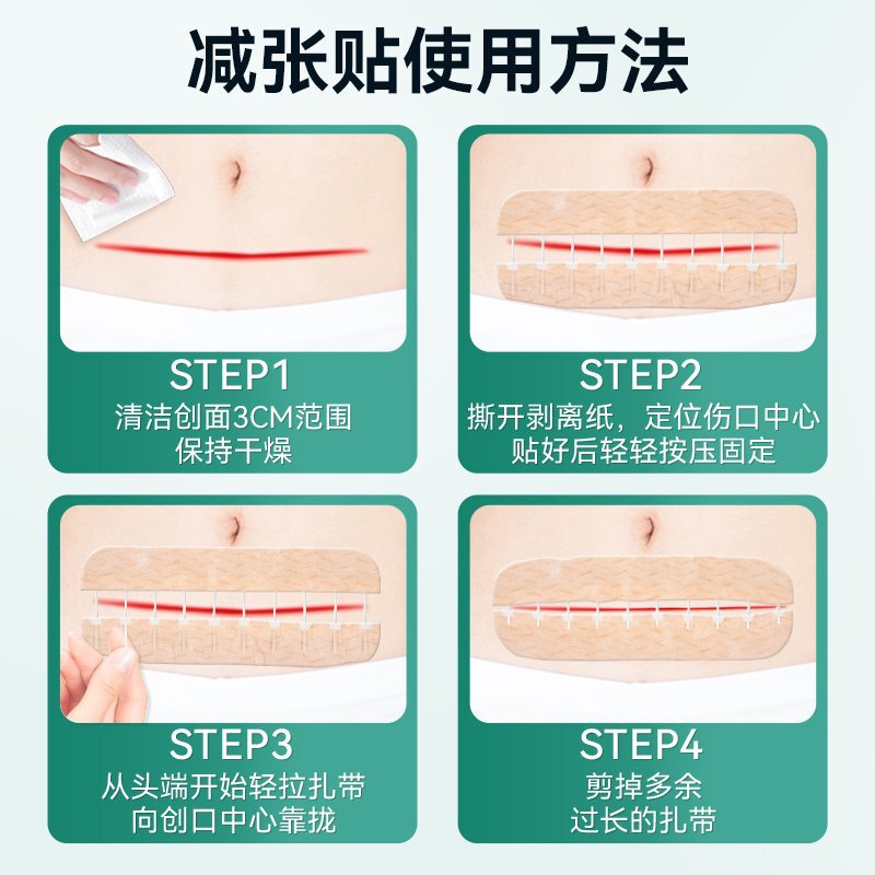 妥能弹性绑带（无纺布）绷带拉合皮肤缝合器拉链式创口贴减张器|undefined